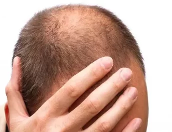 rambut rontok