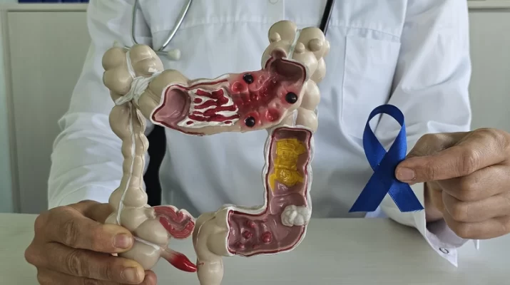 kanker usus